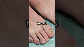 What Is Morton’s Toe [upl. by Dorri]