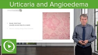 Urticaria Hives and Angioedema – Pediatrics  Lecturio [upl. by Lraed161]