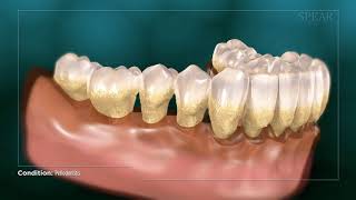 Periodontitis  Gum Disease [upl. by Lichtenfeld]