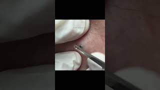 This Weeks TOP Extractions with Dr Pimple Popper [upl. by Annelak199]