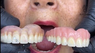 PRÓTESIS DENTAL FLEXIBLE O ACRILICA  🤔🤔 viral odontologia fypシ [upl. by Lorens858]