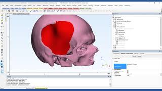 How to Design a PatientSpecific Cranial Plate  Mimics Innovation Suite  Materialise Medical [upl. by Oisor835]