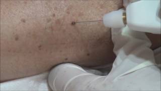 Angioma Removal with Plexr [upl. by Heidt3]