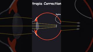 Hypermetropia class 10  correction shorts physics 10thclass animation eye defect refraction [upl. by Mallen]