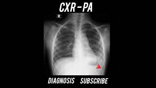 Diagnosis  Chest X Ray  Practical case  Radiology [upl. by Abey499]