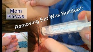 Removing Ear Wax Buildup at Home Flushing Out Ear Wax w Hydrogen Peroxide Ear Irrigation Review [upl. by Ahtilat]