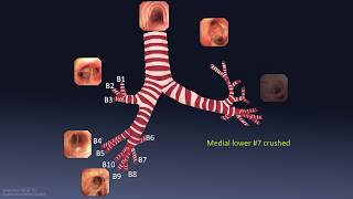 Mastering Bronchoscopy for Thoracic Surgery Chapter 1 [upl. by Alsworth]