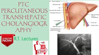 PTCPTHC PERCUTANEOUS TRANSHEPATIC CHOLANGIOGRAPHY Procedure HindiEnglish for BRT amp DRT students🥰 [upl. by Autumn]