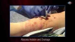 WCW Abscess Incision and Drainage [upl. by Arrakat]