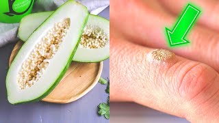 This Is How You Can Get Rid Of Warts For Good [upl. by Ynohtnaed905]