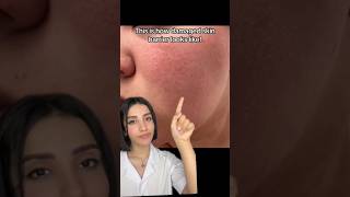 Understanding and Healing a Damaged Skin Barrier  Tipsviral skincare medical [upl. by Yuille]