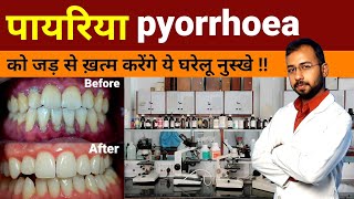 Pyorrhea ka gharelu ilaj  pyorrhea treatment at home  Periodontitis Treatment  pyorrhea symptoms [upl. by Aneetsirk]