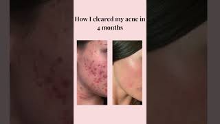 How I cleared my acne in 4 months shorts skincare acne [upl. by Slade783]