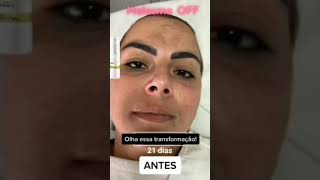 Clareador de Melasma Nutralfit Clareia Manchas definitivamente produtosdebelezaeemagrecimento [upl. by Papagena]