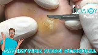 Corn Removal feet κεντροποδιου foot podologos podiatrist corn footcare podiatry callus [upl. by Idnew]