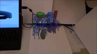 IRCAD  Visible Patient  Hololens AR Visualisation of patient [upl. by Ramhaj]