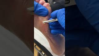 Say goodbye to painful corns and callus Watch an Aussie podiatrist work miracles [upl. by Allenod4]