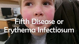 Fifth Disease or Erythema Infectiosum [upl. by Inail]