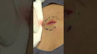 Watch Js story then click over to watch the full procedure Click below to watch drpimplepopper [upl. by Eastman439]