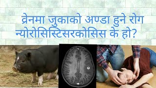 Neurocysticercosis in Nepali doctor sathi [upl. by Narda]