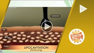 DERMAESTHETIQUE Double chin treatment using lipocavitation amp radio frequency [upl. by Nhoj]