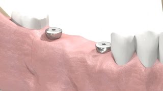 SIC invent Dental Implant  Prosthetic Animation BridgeWork Open Tray Technique [upl. by Biagio974]