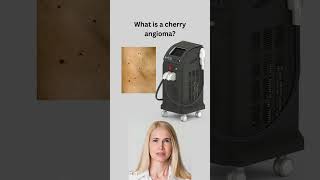 What is a cherry angioma [upl. by Mal]