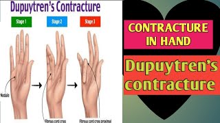 Dupuytrens Contracture in Hindi [upl. by Melleta89]