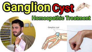 Ganglion cyst homeopathic treatment Drzubair11 [upl. by Eiramacissej]