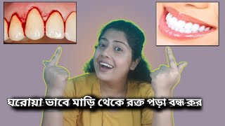 মাড়ি থেকে রক্ত বন্ধ করার ঘরোয়া টিপস।।😃😃🦷 Gum bleeding causes and its treatment at home ।। 😃😃 [upl. by Hephzipa315]