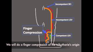 How an incompetent LSV becomes competent instantly [upl. by Oicnedif]