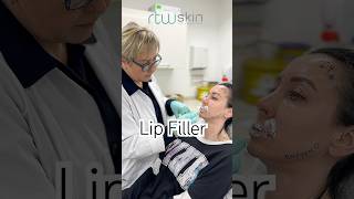 Lip Filler 💋 kentclinic [upl. by Yoko]