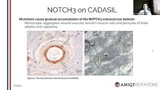 CADASIL  Stroke and Vascular Dementia in adults by Ricardo Carrillo Meza [upl. by Ailil]