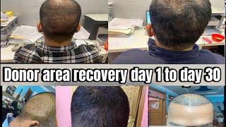 Hair Transplant Donor Area Time Lapse  Donor Area recovery after hair transplant  Day 1 to 15 [upl. by Johppa]