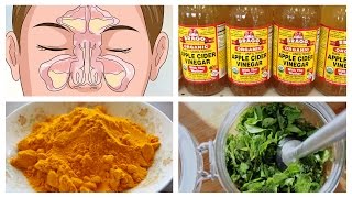 Best Natural Home Remedies for Sinusitis [upl. by Yerffoj]