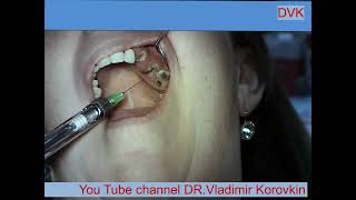 Infiltration Anesthesia for extration 232627 teeth [upl. by Karame306]