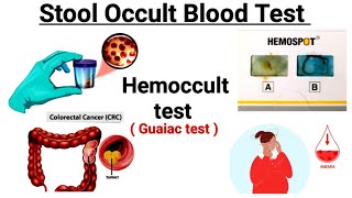 Stool for occult blood test  Hemoccult test  Guaiac test  FOBT [upl. by Jacquelin948]