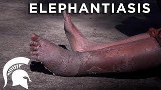 Spartans fight elephantiasis in Tanzania [upl. by Belicia]