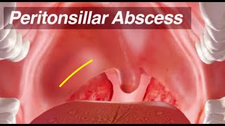 Peritonsillar Abscess  Identification and Treatment [upl. by Flip]