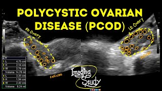 Polycystic Ovarian Disease  PCOD  Ultrasound  Case 43 [upl. by Ispep]