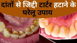 Teeth Tartar Removal Home Remedies दांतों से जिद्दी प्लाक टार्टर दूर करने के घरेलू उपाय Jeevan Kosh [upl. by Maro]