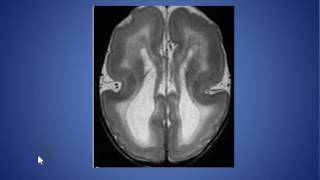 radiolgy cases lissencephaly [upl. by Etnahsal]