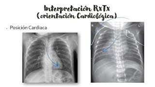 Radiografía de Tórax  Cardiomegalia  Interpretación de la RxTx [upl. by Melissa]