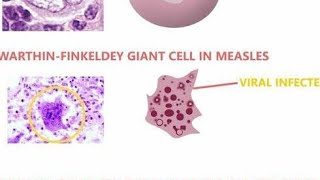 Warthin Finkeldey Giant Cells  Definition Diseases we find them in and Characteristics [upl. by Gillian]