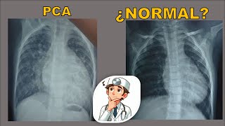 Radiografía en Cardiopatías Congénitas  PCA  Conducto Arterioso [upl. by Alyhc]