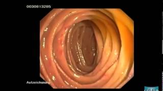 Hereditary Hemorrhagic Telangiectasia OslerWeberRendu Disease [upl. by Rhody]