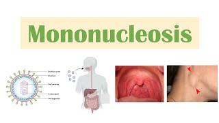 Infectious Mononucleosis Mono  EpsteinBarr Virus Transmission Symptoms Diagnosis Treatment [upl. by Nutsud805]