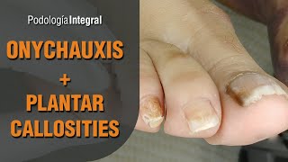 Onychauxis  Plantar callosities Podología Integral Integral Podology [upl. by Ulund657]