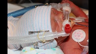 NICU Procedures Bubble CPAP [upl. by Gardner]