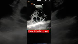 Large hepatic hydatid cyst [upl. by Wehtam]